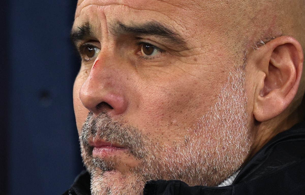 Pojavila se fotografija koja pokazuje kako je Pep Guardiola dobio ogrebotine po glavi i licu Pojavila se fotografija koja pokazuje kako je Pep Guardiola dobio ogrebotine po glavi i licu