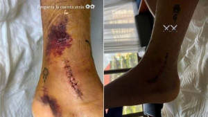 Igrač španskog velikana pokazao zastrašujuću fotografiju lijeve noge nakon teške povrede