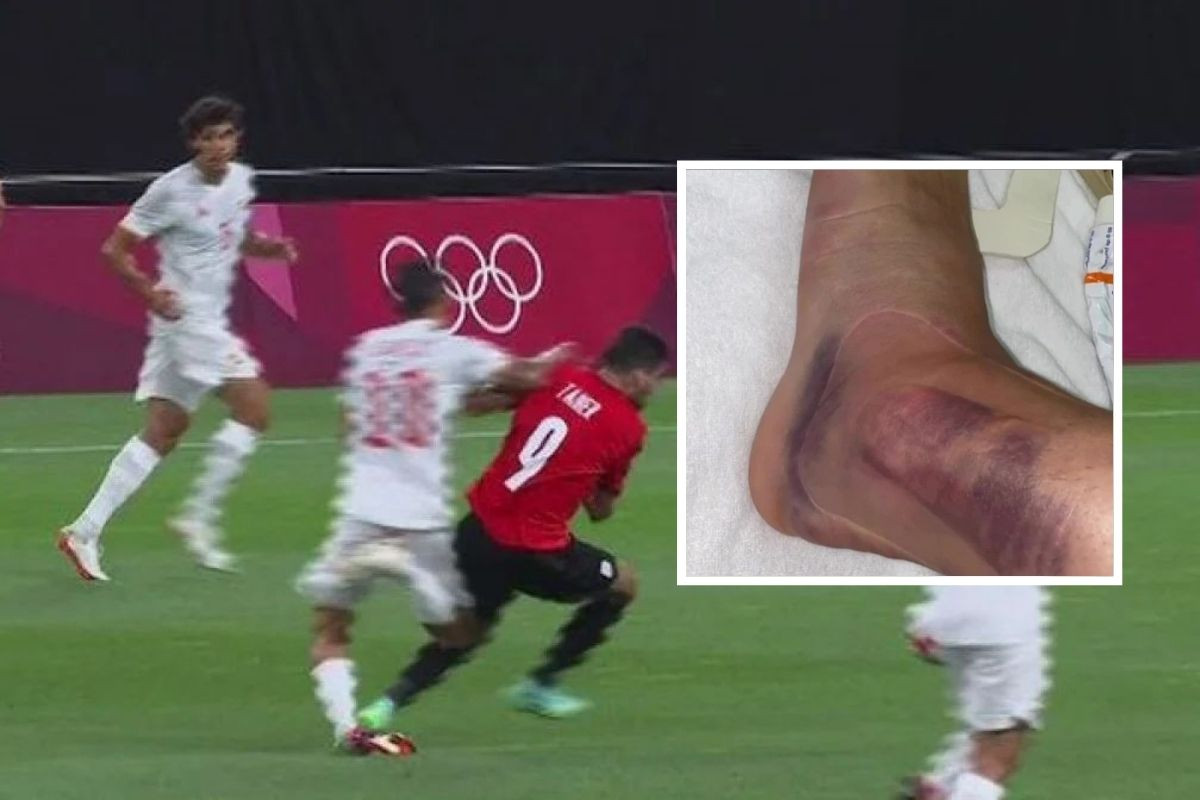 Ceballos objavio kako mu izgleda zglob, a nikome nije jasno kako je izbjegao težu povredu