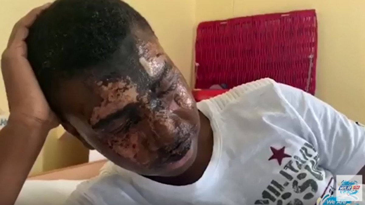 Napali 16-godišnjeg fudbalera, posuli ga kiselinom, pa završili na slobodi Napali 16-godišnjeg fudbalera, posuli ga kiselinom, pa završili na slobodi