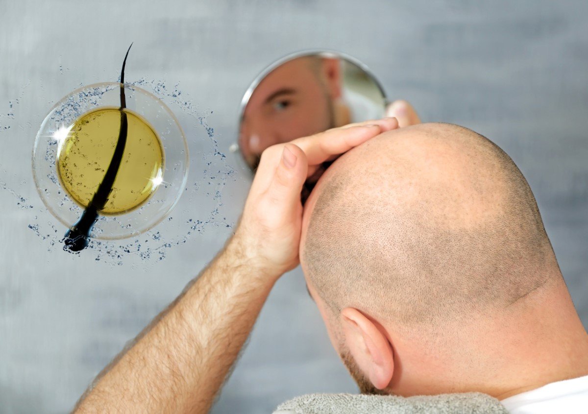 Razmišljate o transplantaciji kose? VatanMed vam u maju nudi posebnu cijenu zahvata
