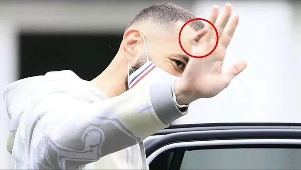 Benzema je otkrio zašto i dalje igra s krivim prstom