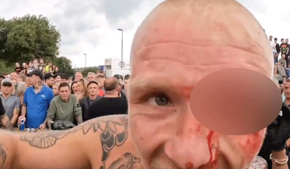Borac ponosno pozirao s najstravičnijom povredom ikad: Nevjerovatna scena dešavala se nakon borbe