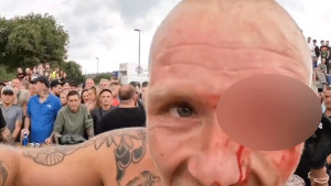 Borac ponosno pozirao s najstravičnijom povredom ikad: Nevjerovatna scena dešavala se nakon borbe