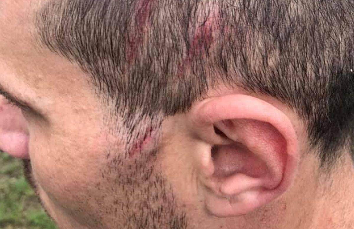 Fudbaler Gornjih Rahića dobio udarac kramponom u glavu, pa njegov klub objavio fotografiju