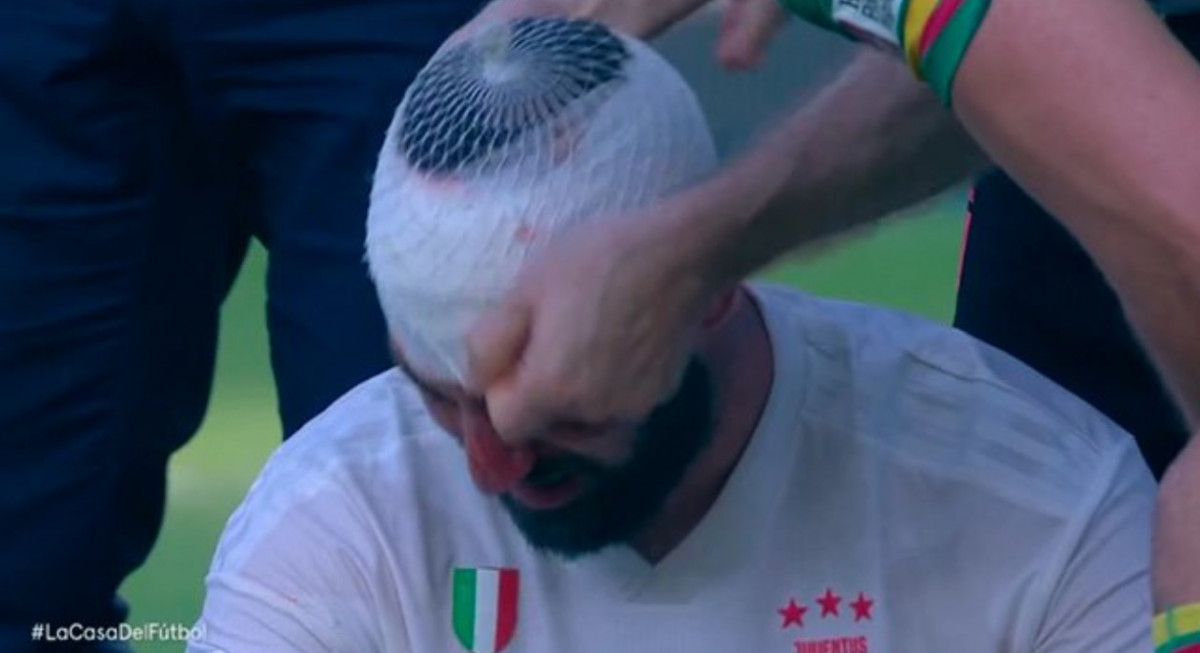 Higuain nastavio igrati sa teškom povredom glave, pa se srušio nakon meča