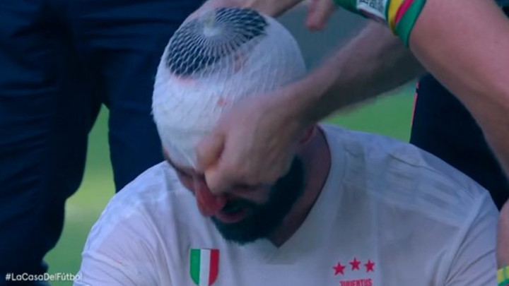 Higuain nastavio igrati sa teškom povredom glave, pa se srušio nakon meča