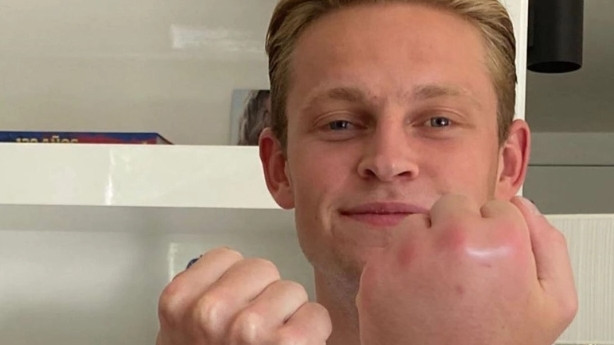 De Jong je imao bizaran problem: Lijeva šaka mu je danima bila duplo veća od desne
