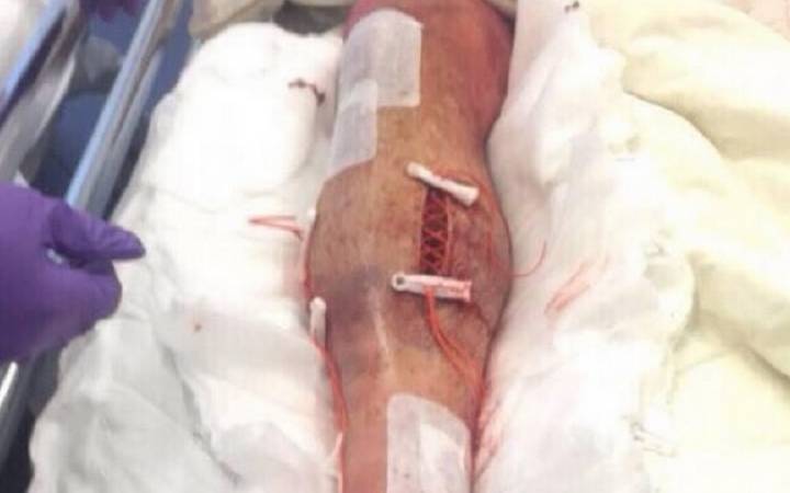 Objavljena fotografija noge Luke Shawa nakon operacije?
