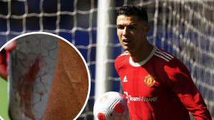 Mislili su da glumi povredu i bez razloga šepa, a onda je Ronaldo skinuo kostobran