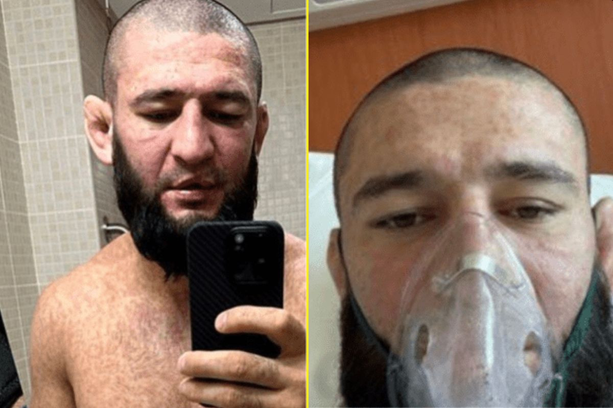 Khamzat Chimaev završio na aparatima: Lice podbuhlo, oči krvave, koža ispucana...