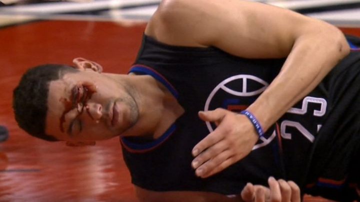 NBA ili MMA? Krvavo lice košarkaša LA Clippersa