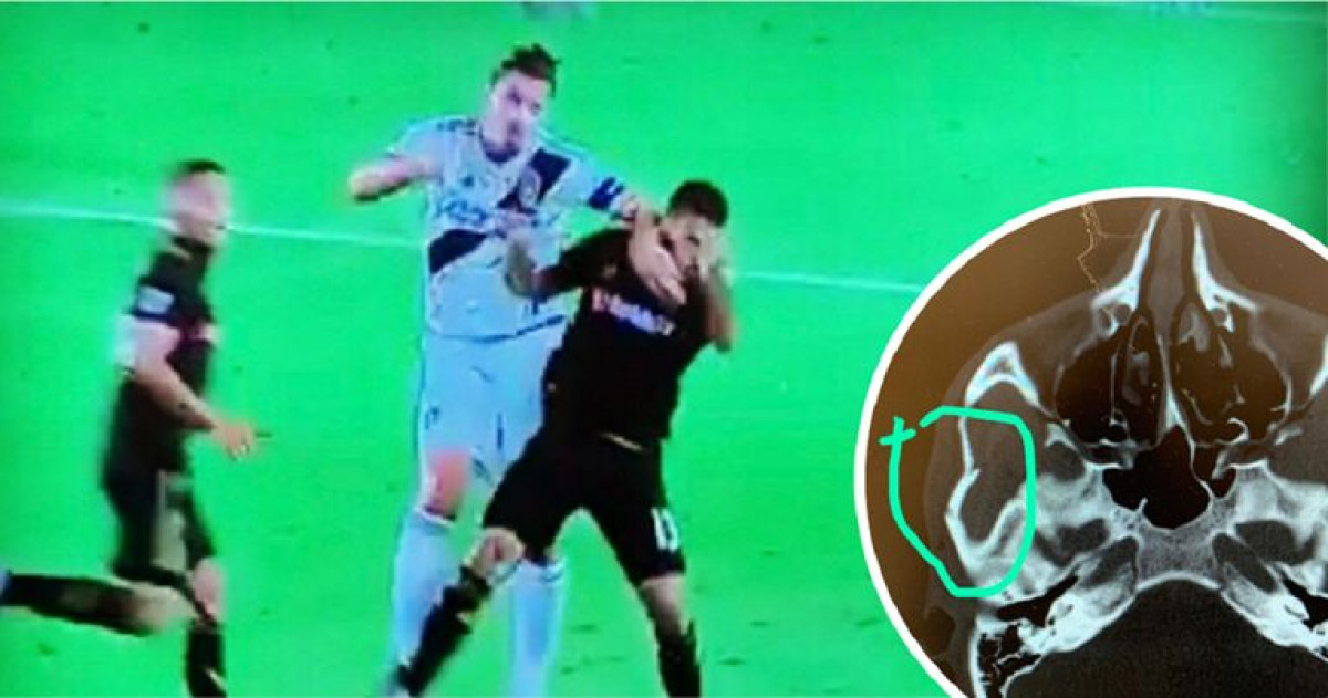 Ibrahimović udario protivnika laktom i razbio mu lobanju
