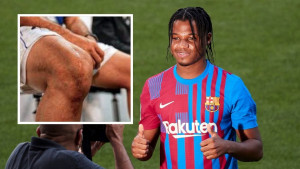 Fotografije pokazuju jeziv ožiljak na koljenu Ansua Fatija koji neodoljivo podsjeća na Ronalda