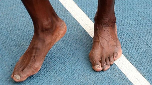 Žuljevi, modrice, gljivice - stopala Usaina Bolta