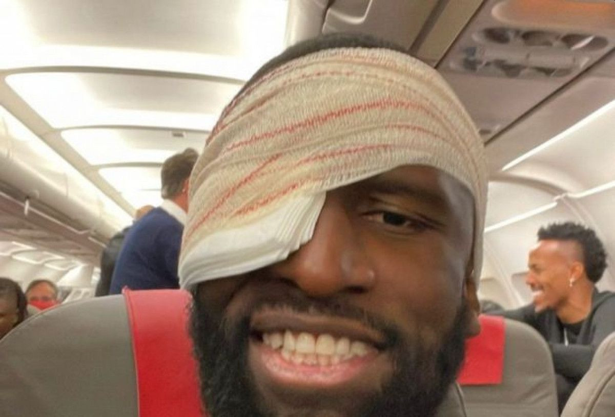 Rudiger pokazao kakav ožljak ima na čelu, ali su svi gledali u njegovo oko koje izgleda baš strašno Rudiger pokazao kakav ožljak ima na čelu, ali su svi gledali u njegovo oko koje izgleda baš strašno