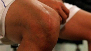 Najpoznatije koljeno u svijetu fudbala: Ožiljci koji su promijenili sve