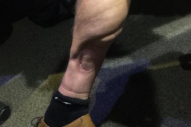 Ovako izgleda noga fudbalera nakon 26 operacijskih zahvata!