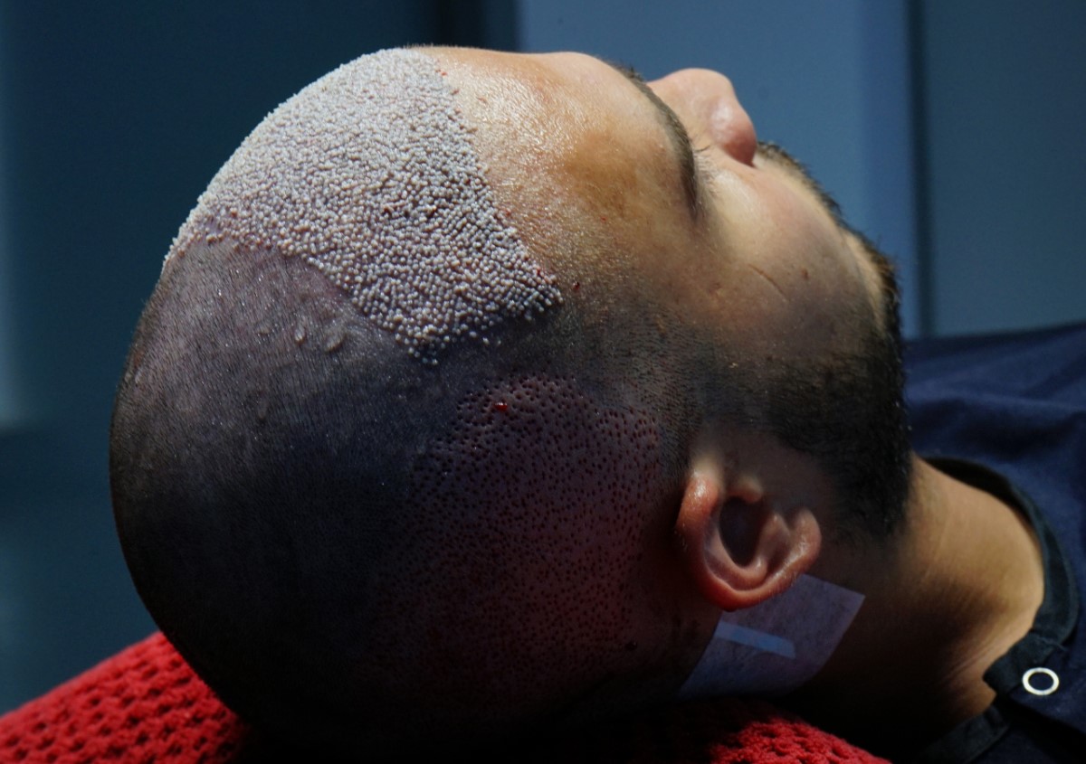 Jedan od savršenih primjera urađene transplatacije kose u klinici VatanMed
